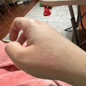 Dove Sabun Kullanımı Sonucu Ellerim Mahvoldu