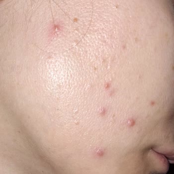 Garnier C Serum Sivilce Yaptı.