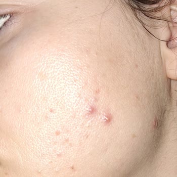 Garnier C Serum Sivilce Yaptı.