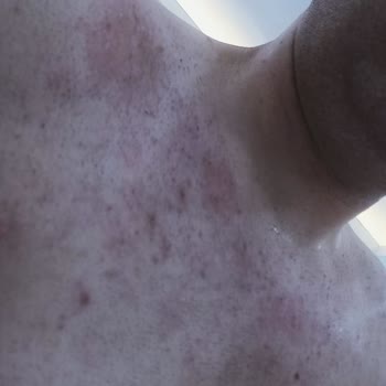 Suit Güzellik Merkezleri Lazer Epilasyon Sonrası Yaşanan Sorunlar Ve Sözleşme İptali Talebi