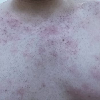 Suit Güzellik Merkezleri Lazer Epilasyon Sonrası Yaşanan Sorunlar Ve Sözleşme İptali Talebi