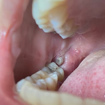 Ankara Üniversitesi Diş Hekimliği Yirmilik Diş Çekimi