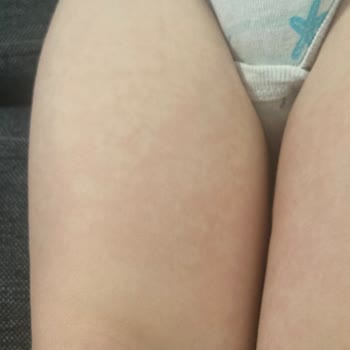 Borline Yumuşatıcısı Çocuğum Da Ve Bende Alerji Yaptı