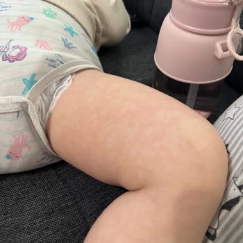 Borline Yumuşatıcısı Çocuğum Da Ve Bende Alerji Yaptı