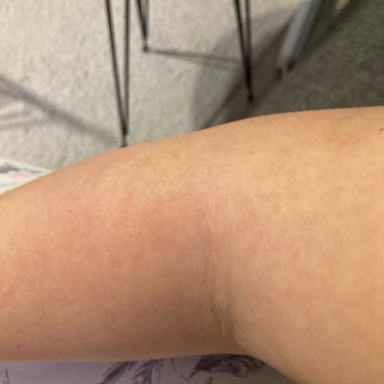 Borline Yumuşatıcısı Çocuğum Da Ve Bende Alerji Yaptı