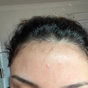 La Roche Posay Duo Akne Karşıtı