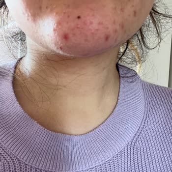La Roche Posay Duo Akne Karşıtı