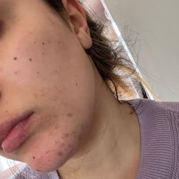 La Roche Posay Duo Akne Karşıtı