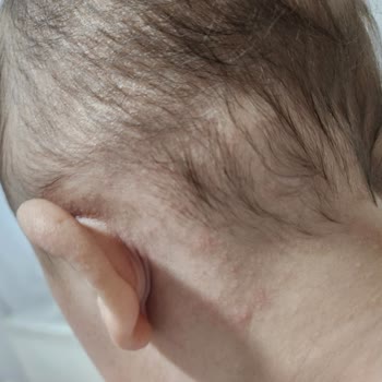 Mustela Nemlendirici Ve Şampuanı Alerji Yaptı