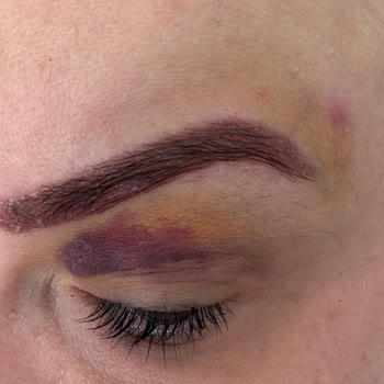 Özgür Kandemirli Beauty Kaş Silme İşleminde Yaşadığım Kötü Deneyim!