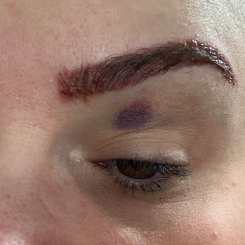 Özgür Kandemirli Beauty Kaş Silme İşleminde Yaşadığım Kötü Deneyim!