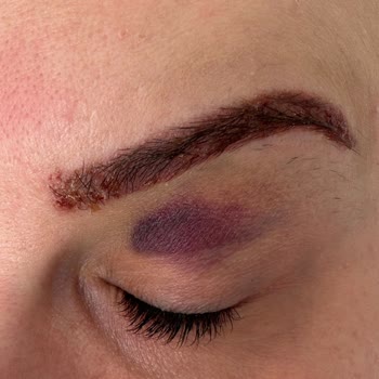 Özgür Kandemirli Beauty Kaş Silme İşleminde Yaşadığım Kötü Deneyim!