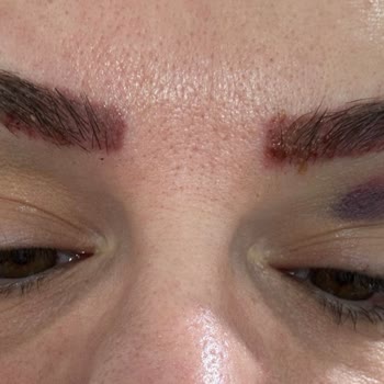 Özgür Kandemirli Beauty Kaş Silme İşleminde Yaşadığım Kötü Deneyim!