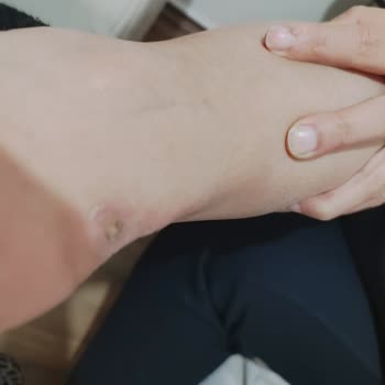 SuperStep Adidas Ayakkabı Yara Sorunu