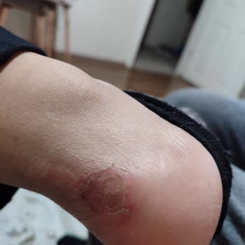 SuperStep Adidas Ayakkabı Yara Sorunu