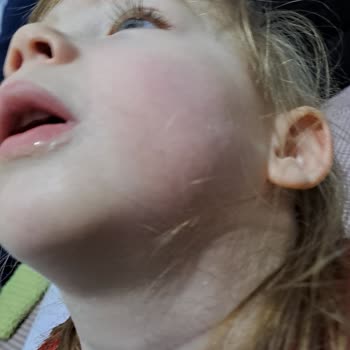 Mustela Gel Arnica Kullanım Sonrası Kızarıklık!