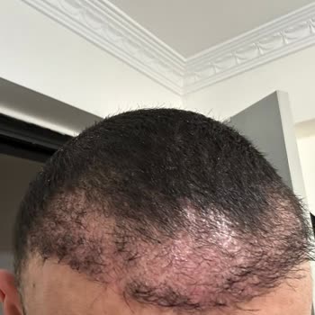 Serkan Aydın Saç Ekimi Ön Hat Ekimi Sonrası Yaşanan Pişmanlık