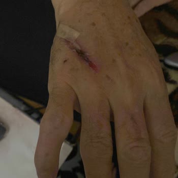 Dökümix 15 Cm' İlk Elde Derin Yanık!