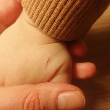 İnnvista Hotel Belek De Başıboş Kediler 2,5 Yaşındaki Oğlumu Tırmaladı.