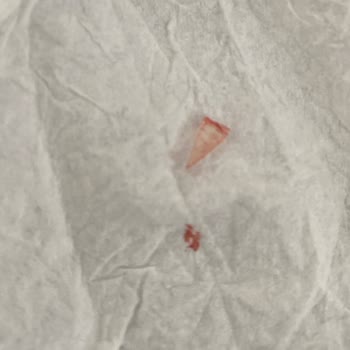 Medova Hastanesi Acilde Yanlış Tedavi/ İhmal