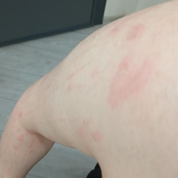 Esse Life Bingöl İki Kolum Epilasyonda Yandı