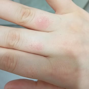 Esse Life Bingöl İki Kolum Epilasyonda Yandı