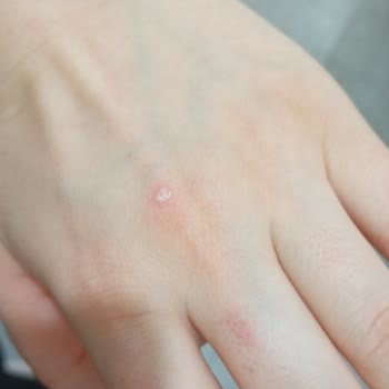 Esse Life Bingöl İki Kolum Epilasyonda Yandı