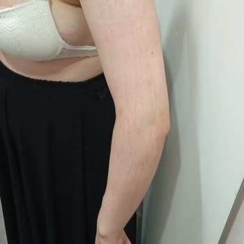 Esse Life Bingöl İki Kolum Epilasyonda Yandı