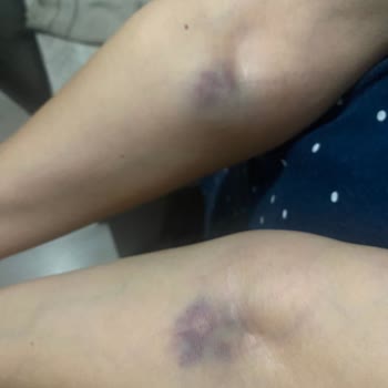 Bursa Çekirge Devlet Hastanesi Kan Alamayan Hemşire