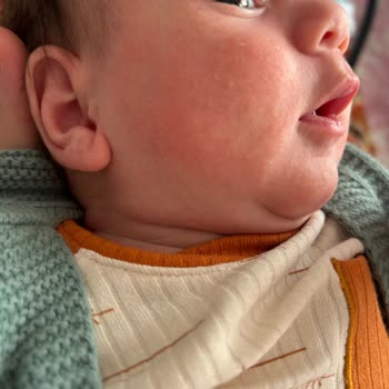 Mustela Yenidoğan Yüzde Kızarıklık