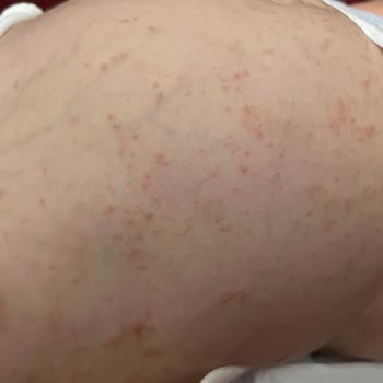 Doruk Yıldırım Hastanesi Cildiye Randevusunda Yaşanan Sorunlar Ve İlaç Şikayeti