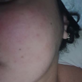 The Purest Solutions Markanın Tüm Ürünleri Yüzümü Mahvetti