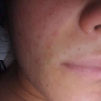 The Purest Solutions Markanın Tüm Ürünleri Yüzümü Mahvetti