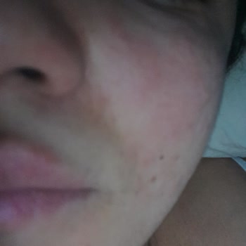 The Purest Solutions Markanın Tüm Ürünleri Yüzümü Mahvetti