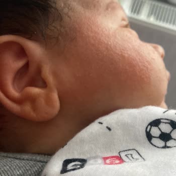 Mustela Şampuan Alerji Yapıyor