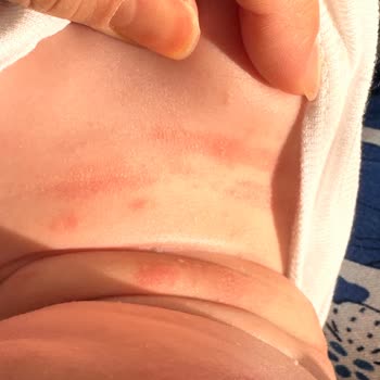Mustela Şampuan Alerji Yapıyor
