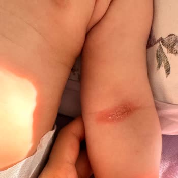 Mustela Şampuan Alerji Yapıyor