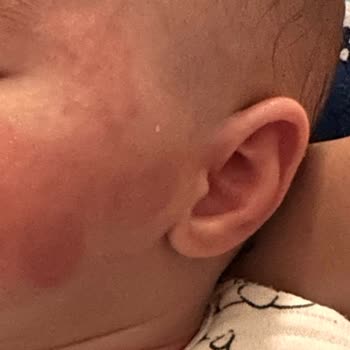 Mustela Şampuan Alerji Yapıyor