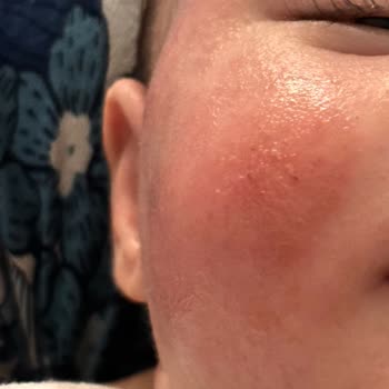 Mustela Şampuan Alerji Yapıyor