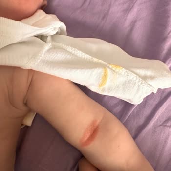 Mustela Şampuan Alerji Yapıyor