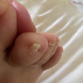 Estefoot El ve Ayak Bakım Merkezi Batık Tırnak Bandı