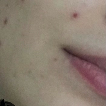 Gratis Lkyd Kapatıcısı Yüzümü Mahvetti