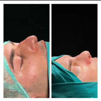 Op. Dr. Uğur Harputluoğlu Burun Estetiği Mağduru