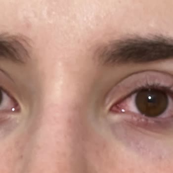 Kiehl's Ürün Alerji Yaptı. Ürünün İadesini İstiyorum