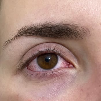 Kiehl's Ürün Alerji Yaptı. Ürünün İadesini İstiyorum