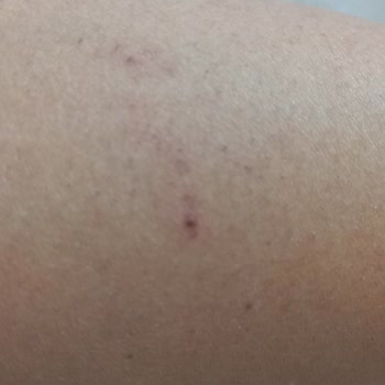 Bercislina Güzellik Merkezi İzmir Şirinyer'de Lazer Epilasyon Mağduriyeti