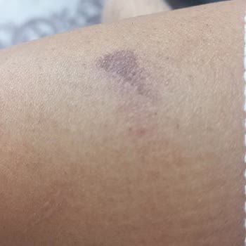 Bercislina Güzellik Merkezi İzmir Şirinyer'de Lazer Epilasyon Mağduriyeti