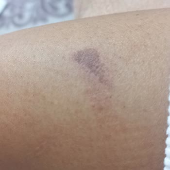 Bercislina Güzellik Merkezi İzmir Şirinyer'de Lazer Epilasyon Mağduriyeti