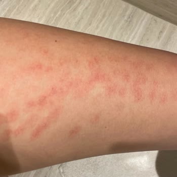 Epiderm Epilasyon Merkezi Epiderm Bakırköy Şubesi Bacaklarımı Yaktı