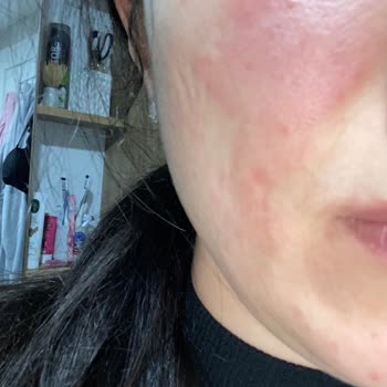 Loreal Nemlendirici Krem Cildimde Yanıklara Sebep Oldu